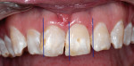 Figure 3  Preoperative planning included model and photograph analysis. Marked images were taken to the operatory to guide tooth reduction. In this case, preparation also needed to include compensation for cant, midline position, and tooth proportion