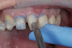 Figure 9  Immediate dentin sealing included etch, DBA, and separating medium. 100% of the tooth surfaces were etched for 15 seconds, rinsed thoroughly, and left moist. DBA was then placed in at least two coats.