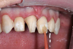 Figure 14  The pre-bonded preparations were cleaned thoroughly with alcohol and roughened lightly with a finishing diamond. After veneer try-in and bonding, the incisors were etched, then the DBA was applied and air-thinned.