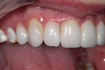 Figure 16  Soft-tissue health was excellent and there was no evidence of microleakage associated with IDS in this case. The most problematic area of crowding with the largest area of dentinal exposure was improved, and the completed smile rehabilitat