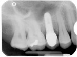 Figure 3  Radiograph of osseointegrated Biodenta tissue-level implant restored with Biodenta stock abutment and porcelain-fused-to-zirconium crown.