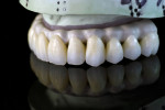 The milled zirconia fullcontour crowns assembled on the framework and refined prior to glazing.