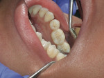 Figure 1  Teeth Nos. 19 and 20 exhibited stain in the pits and fissures of the occlusal surface. Upon probing with a sharp explorer, there was no resistance to removal or softness at the base of tooth No. 20. Tooth No. 19 had an existing sealant that