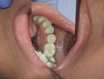 Figure 3  Teeth Nos. 19 and 20 after tooth preparation. Notice that the preparation ended in dentin after complete caries removal.