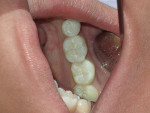 Figure 7  Completed restorations on teeth Nos. 18 through 20.