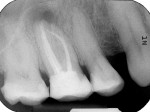 Figure 1  Radiographs showed an apical translucency and that a separated root canal instrument extruded out of the mesio-buccal root of tooth No. 16.