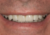 Fig 9. Note the significant osseous defect in the buccal osseous wall following atraumatic tooth extraction.