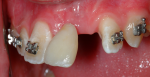 Fig 5. A bonded denture tooth was used to improve esthetics and provide orthodontic guidance for space closure.