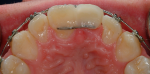 Fig 7. Space closure was created with proper mesial-distal proportions for replacement of the missing tooth.