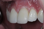 Fig 19. The final implant porcelain crown in the left central incisor position (crown produced by Toshiyuki Fujiki, RDT); direct bonding was used on the right central incisor.