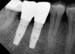 Fig 10 and Fig 11. In a single healed molar extraction site where the ridge was too narrow to place one wide implant (Fig 10) two 4.1-mm diameter implants were placed (Fig 11). The distance between the teeth at the level of the alveolar crest was 14.5 mm and the width of the ridge was 6.8 mm. Placing two narrower implants allowed the ITD to the adjacent teeth to be minimized. This case may be restored as either two bicuspids or one molar with a small cleansable embrasure between the implants.