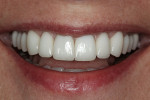 Figure 11  Bilateral harmony and optical consistency allow the patient to confidently present her smile in personal and business situations.