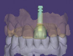 Fig 6. Full-contour crown designed onto the Ti base.