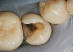 Figure 3  Decay was removed and the internal cavity preparation was completed with an 1157 round-end fissure bur. Proximal margins were still irregular at this point.
