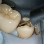 Figure 5  When the proximal box margin is still in enamel, a shallow bevel can be placed to enhance bonding.