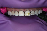 Once the teeth were properly cleaned, particle abraded, and total etched, a universal adhesive was placed and light cured.