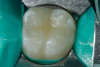 Figure 7  Proper adaptation and trimming of a whitening tray on a maxillary cast. Tray showing both the buccal and lingual aspects scalloped.