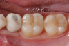 Figure 9  Prior to at-home whitening. Following approximately 10 days of at-home tray whitening.