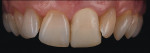 Figure 7  Images shot with the paper diffuser technique. The colors in the dentition b.come more apparent against a black contrast.