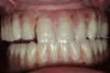 Figure 15  The digital veneer has been placed over the zirconia substructure to express the excess fusion porcelain at the margins.