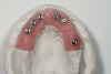 Figure 18  Facial view of the cemented crowns for teeth Nos. 2 and 3.