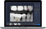 An example of an AI-enhanced dashboard showing a bitewing radiograph with AI annotations to support hygienist and clinician communication with each unique patient. Findings include but are not limited to caries, compromised margins, bone levels, and furcation involvement. (Image courtesy of Overjet, Inc.)