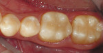 Figure 9  Occlusal view of the.completed Tetric EvoCeram Bulk Fill restorations.