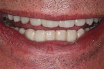 Fig 16. Close-up view of patient’s smile 16 days post-delivery.