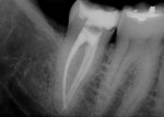 Figure 3  Radiograph of canals instrumented with the WaveOne Reciprocating File, courtesy of Dr. William Nudera, Bloomingdale, Illinois. Small WaveOne Reciprocating Files were used in the mesiobuccal and mesiolingual canals and one Primary file was u