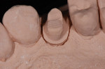 Figure 5  Uncut model. Note the ideal margins and optimal retraction details transferred to the laboratory.