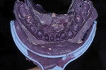 Figure 11  A triple-tray impression. The preparation has the necessary detail, but the impression does not capture the architecture of the gingival tissues.