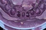 Figure 12  Note the lack of detail of the facial gingival tissues apical to the margin.