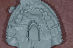 Figure 14  A full-arch triple tray. Note the complete lack of detail of the opposing arch. The impression did not seat and the material pulled.