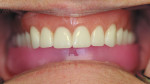 Figure 3  An occlusal wax rim was used to evaluate the arrangement and function of the mandibular teeth.