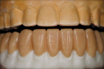Figure 6  Full contour wax-up of the e.max Press crowns.