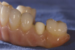 Figure 10  Ten of the 12 tooth restorations were bonded into place on the zirconia substructure.