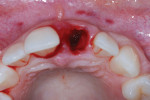Maxillary occlusal view of the extraction site after mechanical and rotary instrument debridement showing buccal palatal width. Care must be given to the spatial placement of the one-piece zirconia implant.