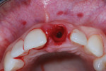 Maxillary occlusal view of the osteotomy site preparation, which was initially created with a 2.3-mm all-ceramic twist drill and then subsequently widened into a 3.75-mm apically prepared osteotomy site.