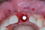 Occlusal view of the maxillary left central implant site exhibiting a buccal void between the implant surface and the residual buccal plate and soft tissues.