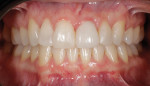 Postoperative retracted clinical view of the final implant-retained crown (IPS e.max®, Ivoclar Vivadent) with teeth in maximum intercuspation. The final restoration was cemented (RelyX™ Unicem 2, 3M) 5 months after the initial surgical procedure.