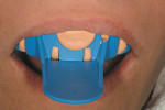 Figure 1  Using a PVS/sectional tray template, the rubberized-urethane provisional resin (TuffTemp) was placed and the template seated in the maxillary arch.