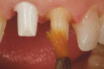 Figure 2  Crown preparations for an implant–abutment maxillary right central incisor and natural-tooth left central incisor. A water-soluble lubricant (Wink) was painted on the prepared surfaces as a release agent.