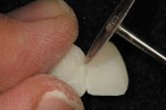 Figure 4  The provisional resin was removed after setting. It was adjusted and shaped using a diamond disk and an acrylic bur in a slow-speed handpiece; facial lobular form was created with a cross-cut fissure bur in a straight nose-cone slow-speed h