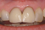 Figure 1  Preoperative view of existing pressed all-ceramic crowns.