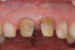 Figure 2  Discolored preparations on teeth Nos. 8 and 9.