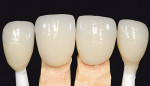 Figure 4  Lithium-disilicate veneers on custom-shaded stump dies matched to Captek Nano crowns on teeth Nos. 8 and 9.