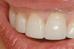 Figure 7  Clinical try-in of the crown with large porcelain margin on tooth No. 9.