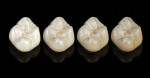 Figure 2  ZEUS full-contour restorations by MicroDental Laboratories are indicated for crowns, bridges, and screw-retained implant crowns. Essentials ZEUS restorations are indicated for posterior single units.