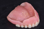 Existing denture of presenting patient with compromised esthetics.