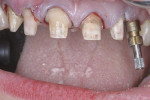 Figure 7  The implant in the position of tooth No. 11 was captured with a closed-tray impression.